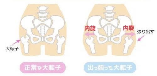 大転子 歪み解説